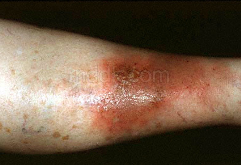 Is cellulitis contagious?