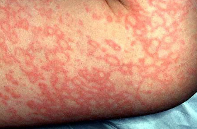 Life-Threatening Skin Rashes Causes, Symptoms, Treatment ...