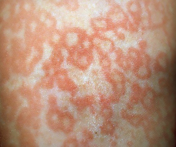 Fifths Disease Rash Pictures Pictures Photos