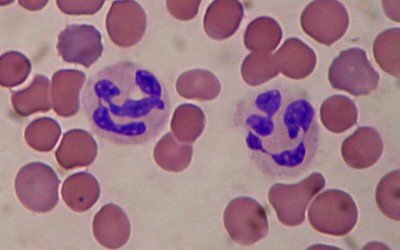 leukocytosis