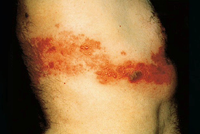 Pictures of STDs: Herpes, Genital Warts, Gonorrhea, STD ...