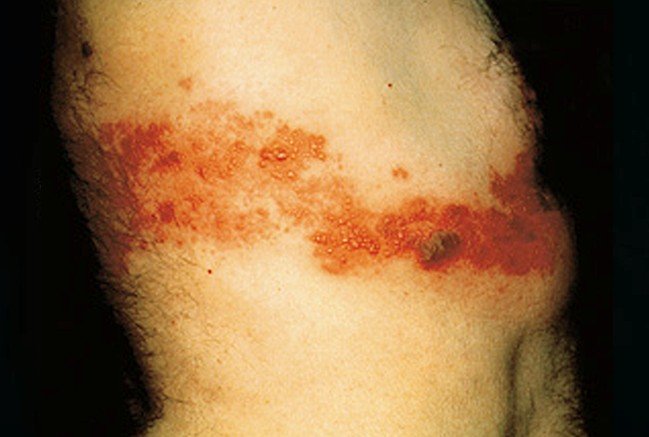 Pictures of STDs: Herpes, Genital Warts, Gonorrhea, STD ...