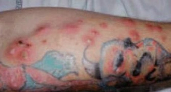 Tattoo Infection - Pictures, Signs, Symptoms, Causes ...