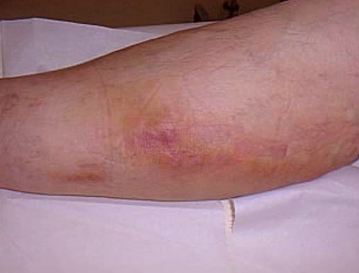 Symptoms Of Migratory Thrombophlebitis - HealthTap