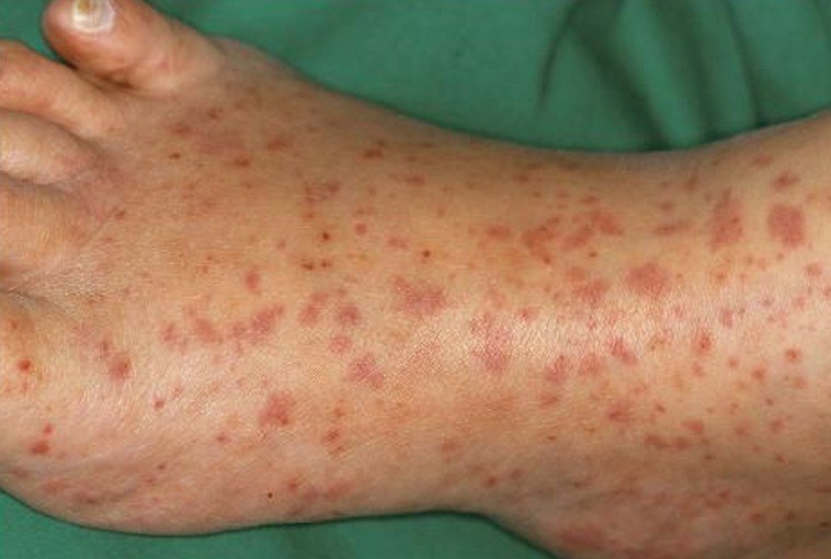 what causes rash on legs pictures, photos