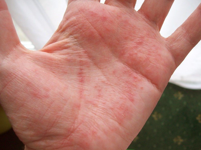 sores on hands