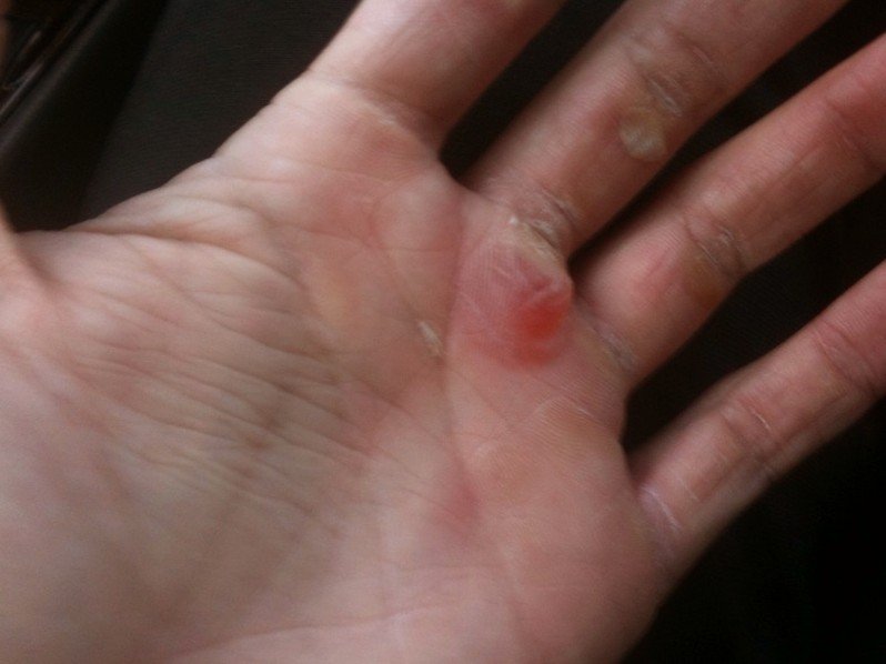 itchy blisters on hands #9