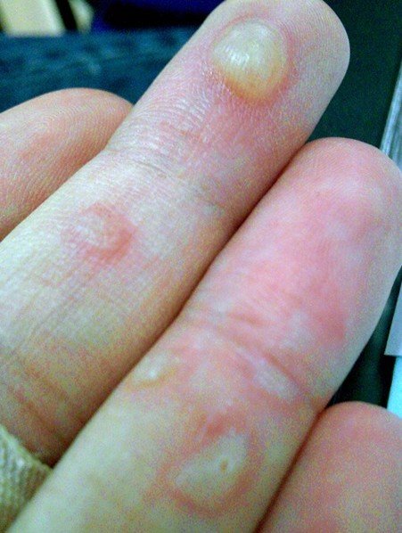 clear blisters on hands - Dermatology - MedHelp