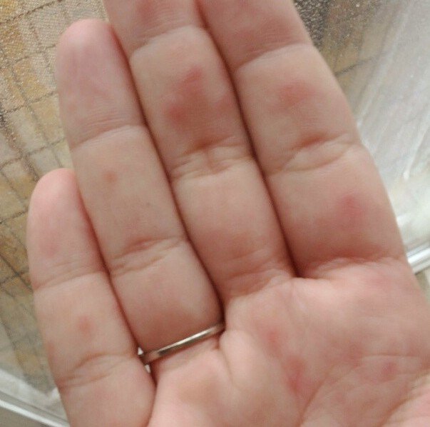 Blisters On Hands Pictures Causes Treatment