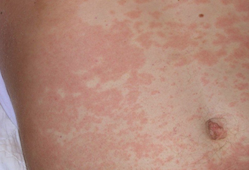 Chikungunya Virus Infection and Rash - treato.com