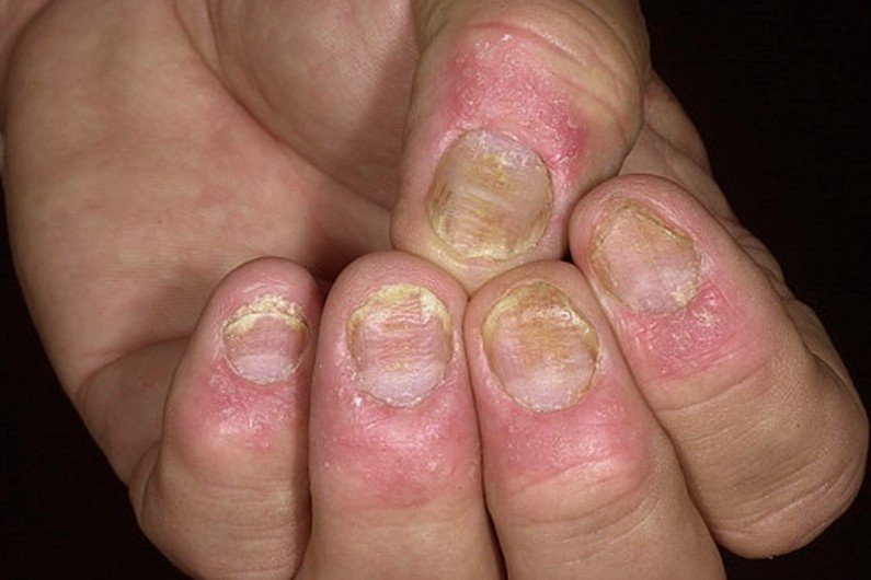 Nail Psoriasis Treatment, Home Remedies, Pictures & Facts