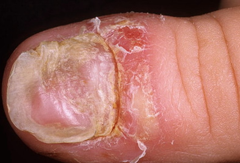 nail psoriasis treatment #11