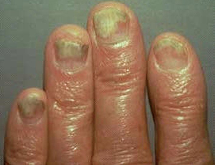 nail psoriasis treatment pictures, photos