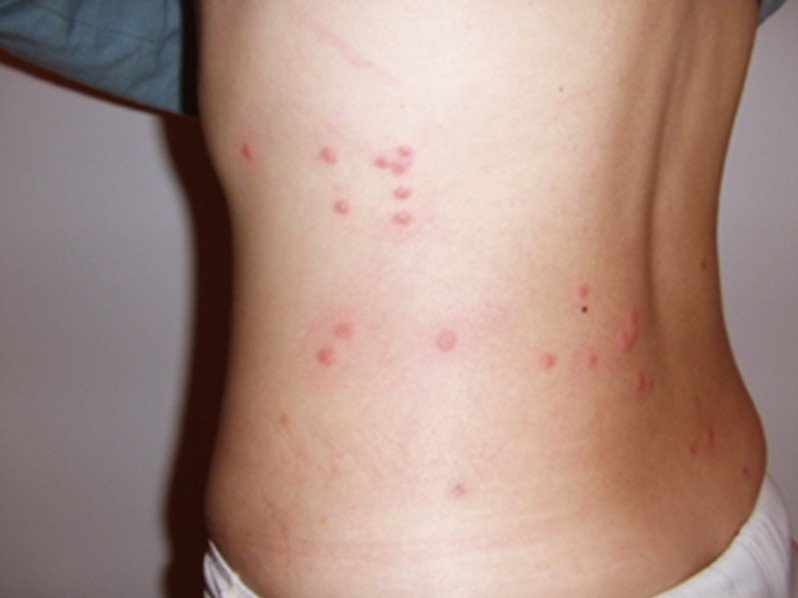 pictures of hives in children