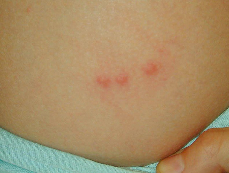 urticaria causes