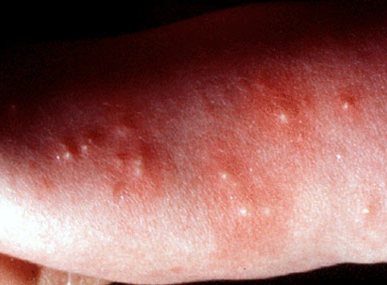 Urticaria, Papular - WebMD