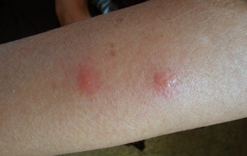 papular-urticaria-picture-pictures-photos