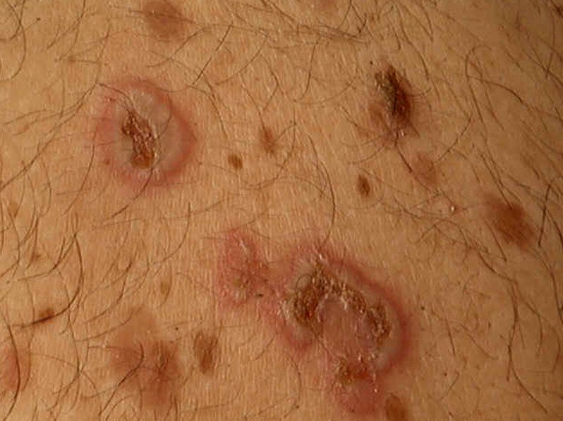 Pemphigus vulgaris - Wikipedia