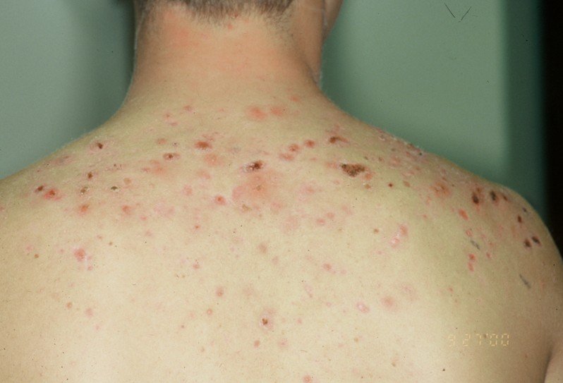 Causes of a Rash on the Scalp Skin | LIVESTRONG.COM