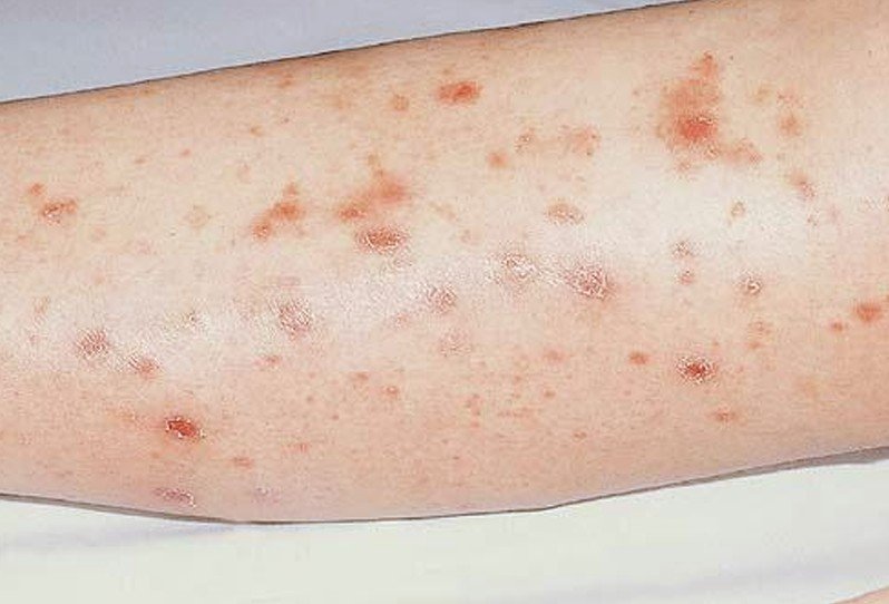 pityriasis-lichenoides-pictures-causes-symptoms-treatment