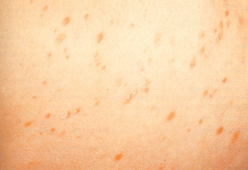 What Is Pityriasis Lichenoides