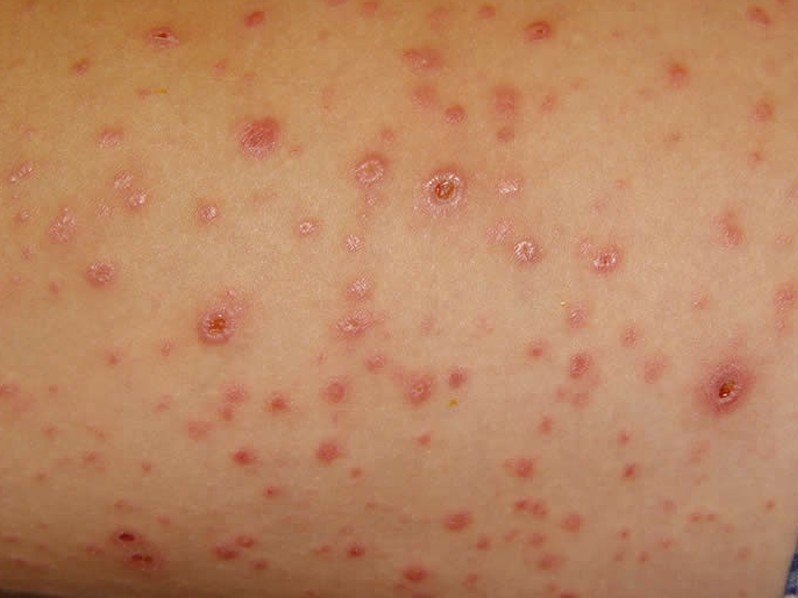 Pityriasis Rosea Treatment Pictures Photos