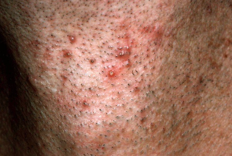 Pseudofolliculitis barbae - Huidarts.com