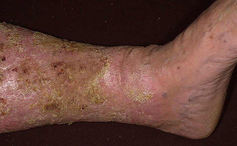 Stasis dermatitis and ulcers: MedlinePlus Medical Encyclopedia