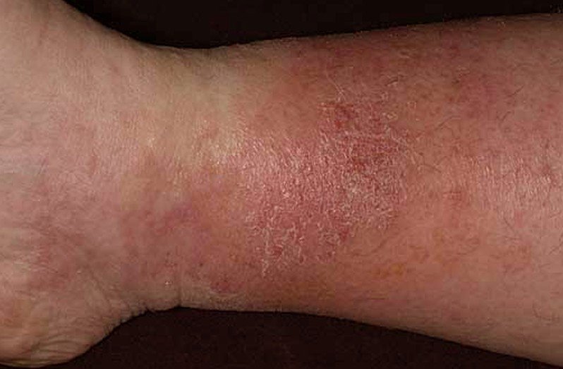 what is stasis dermatitis #11