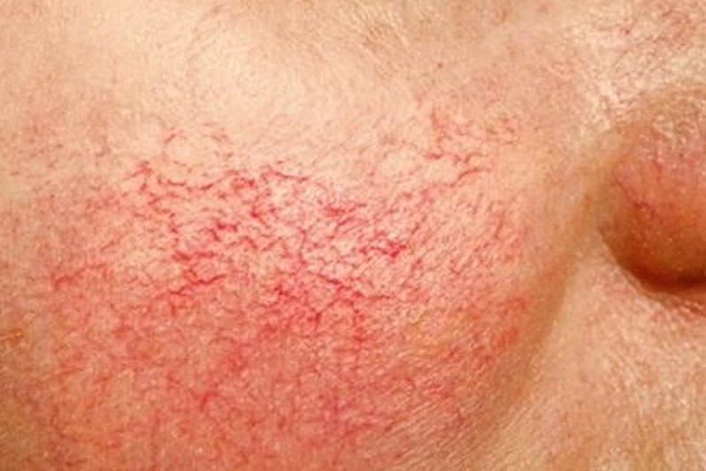 Telangiectasia in Adults: Condition, Treatments, and ...