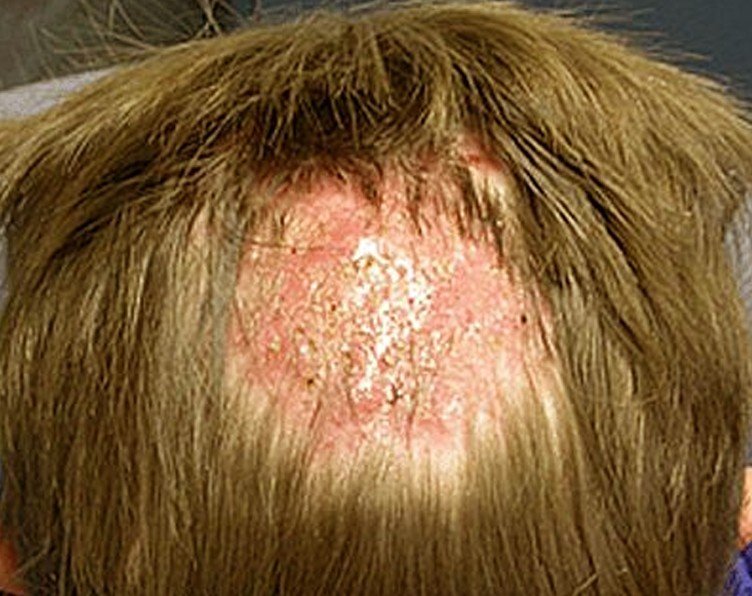 tinea capitis scalp