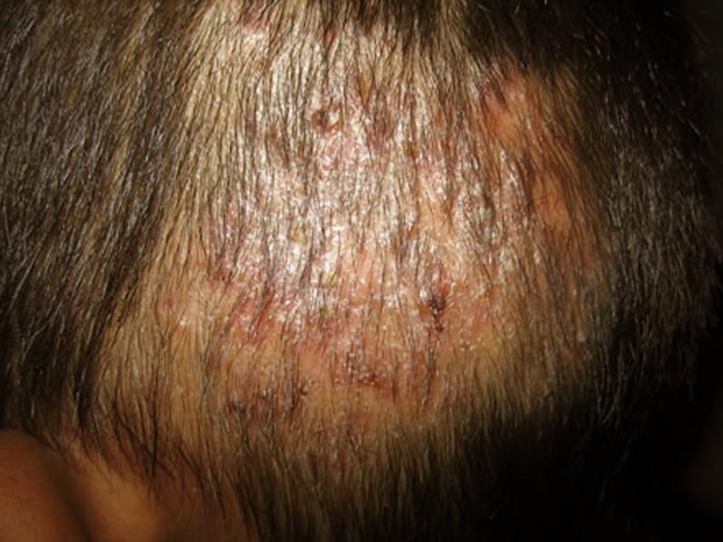 Scalp Psoriasis and Similar Head Rashes – Pictures ...