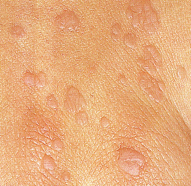 Warts (Common Warts) Pictures, Causes, Types ... - MedicineNet