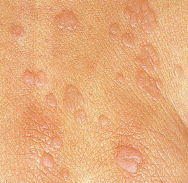 Warts (Common Warts) Pictures, Causes, Types ... - MedicineNet