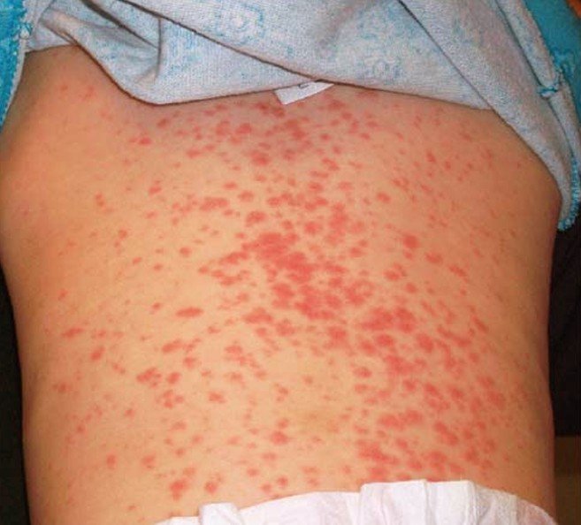 can amoxicillin cause swelling in legs