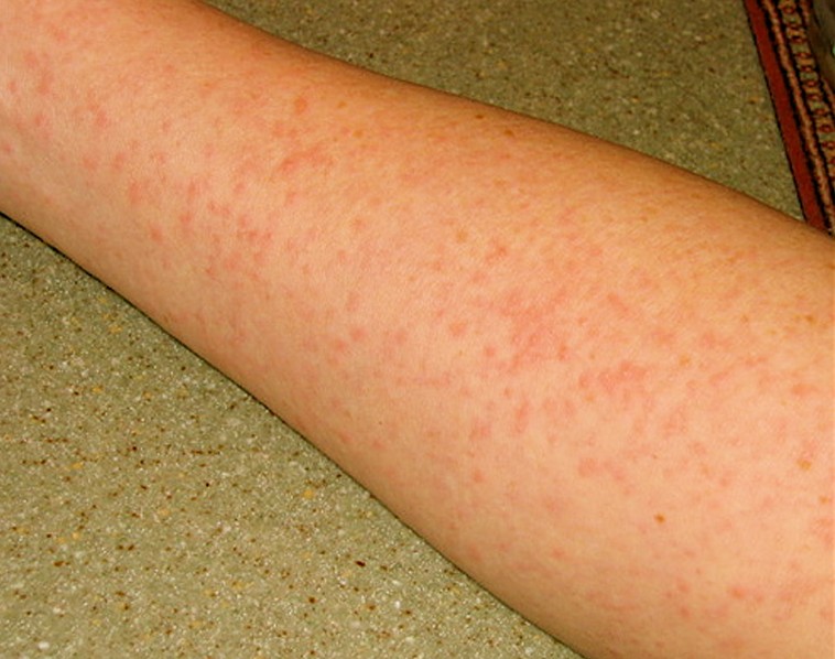 can amoxicillin cause swelling in legs