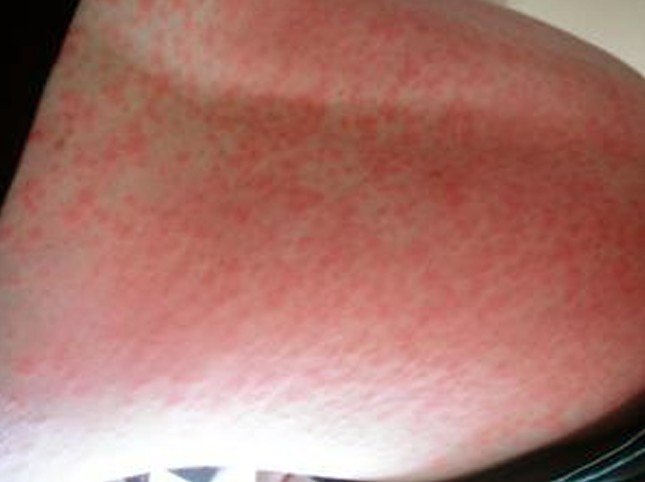 can nitrofurantoin cause rash