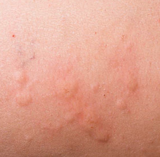 non allergic amoxicillin rash treatment