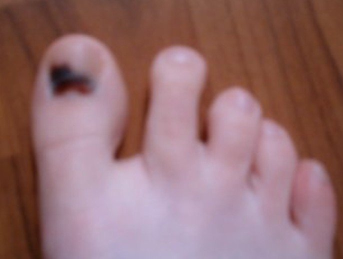 bruised-toenail-pictures-healing-time-causes-treatment