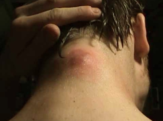 Bumps on Back of Head, Skull, Painful, Neck, after Haircut ...