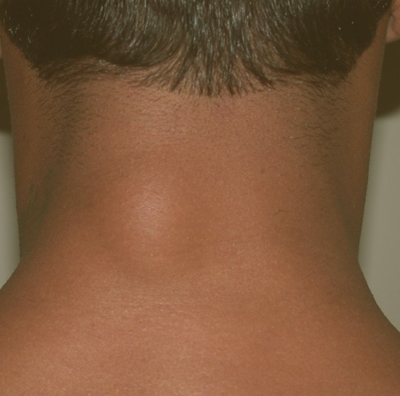 What Can Cause A Lump On The Back Of The Neck Hairline The Best Porn
