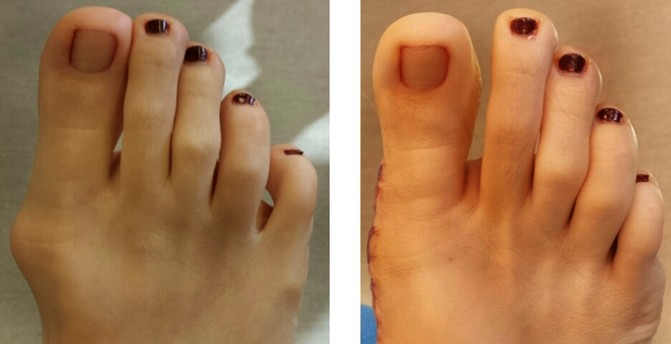 Bunion Surgery before and after photos.
