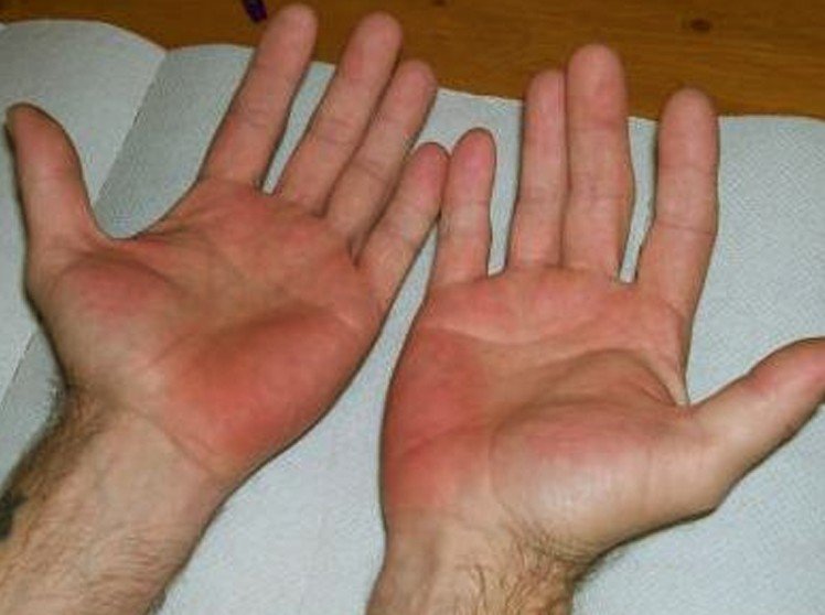 Red spots of the palms of hands and soles of feet ...