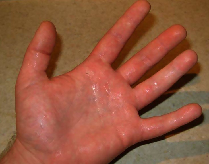 Doctor insights on: Red Blotches On Palms Of Hands - HealthTap