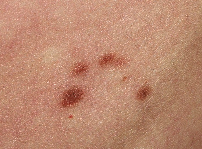 Urticaria Pigmentosa Pictures Symptoms Causes Treatment