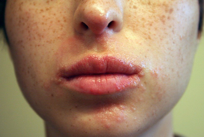 pimples-around-the-mouth