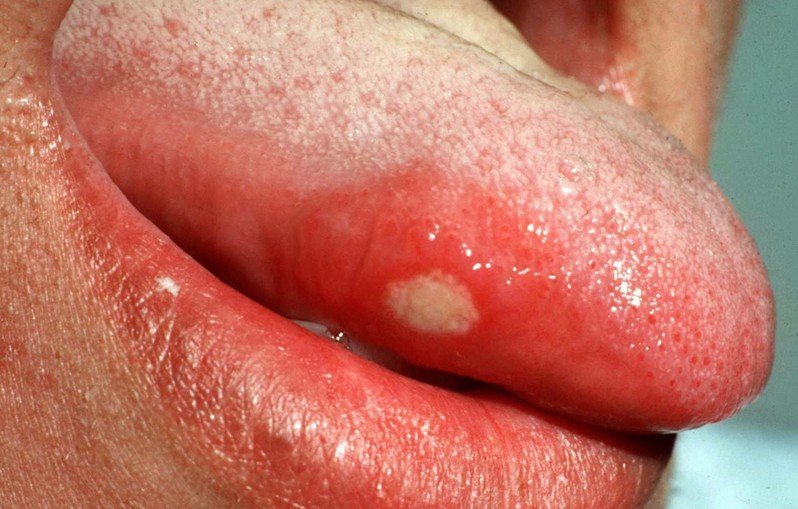 aphthous ulcer