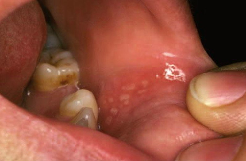 Canker Sores: Causes & Treatments - Live Science