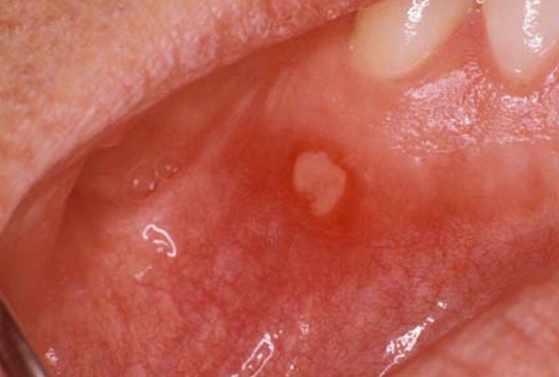 aphthous ulcer pictures #10