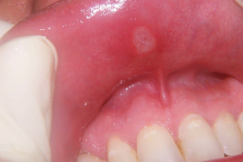 Aphthous stomatitis - Wikipedia